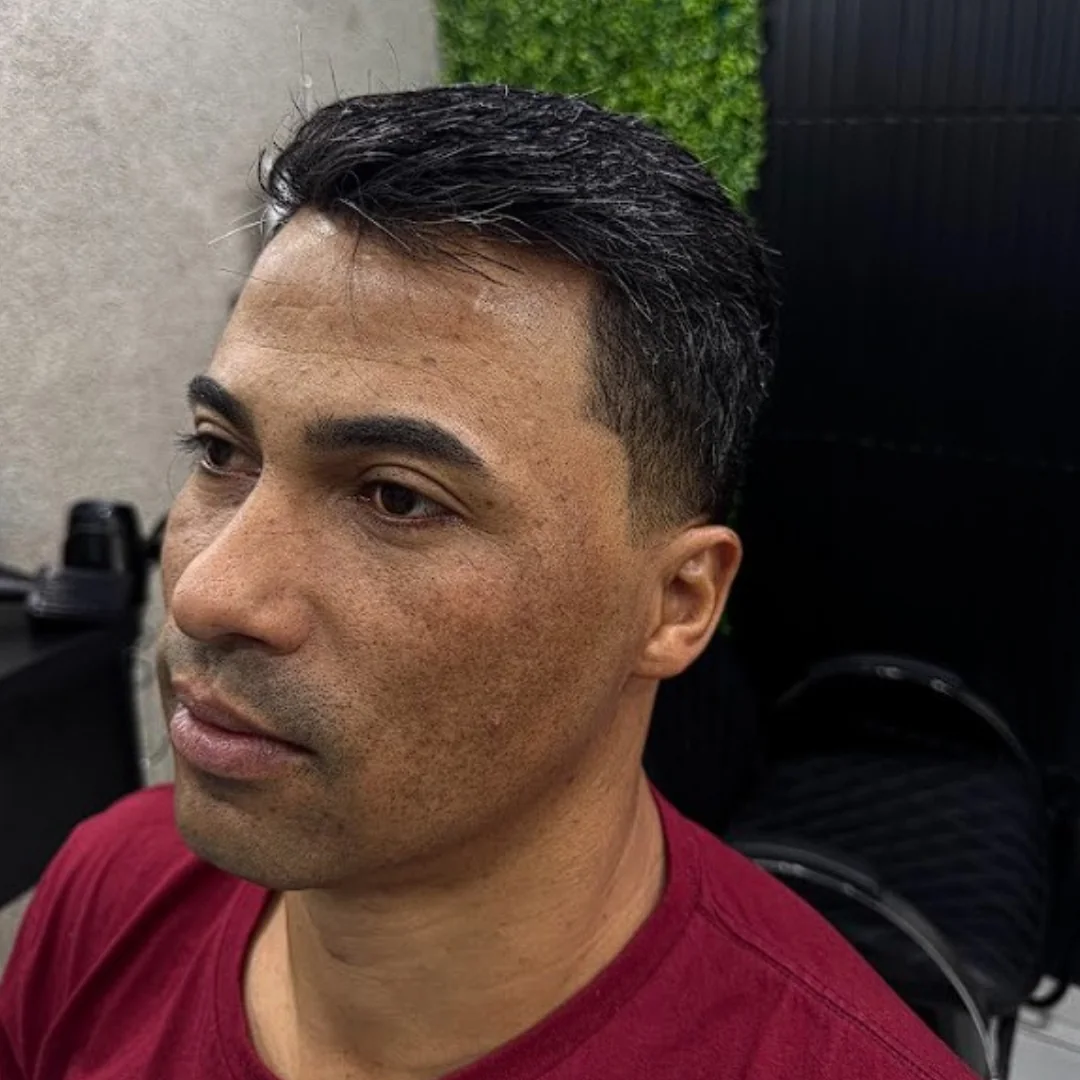 Cliente 02 depois da prótese capilar