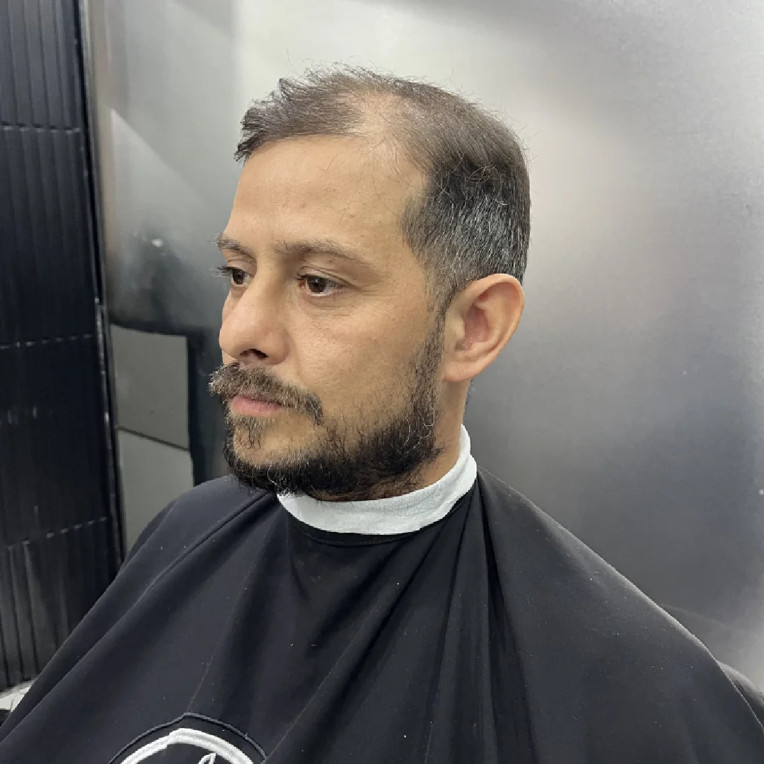 Cliente 03 antes da prótese capilar